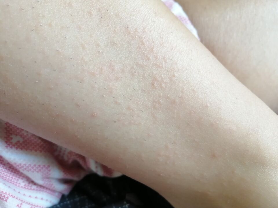 Rashes on Elena's legs before using Germivir tablets