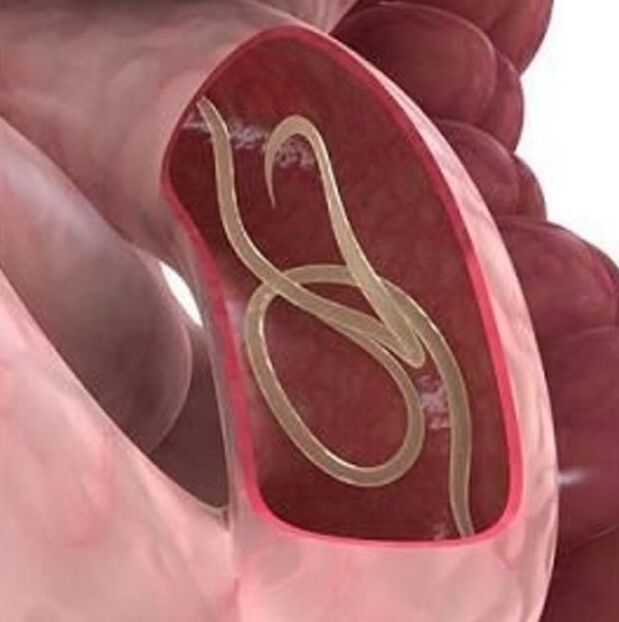 Signs of worms in a person in the stomach tract