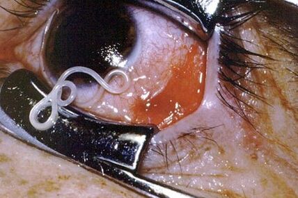 Worms into a person's eyes